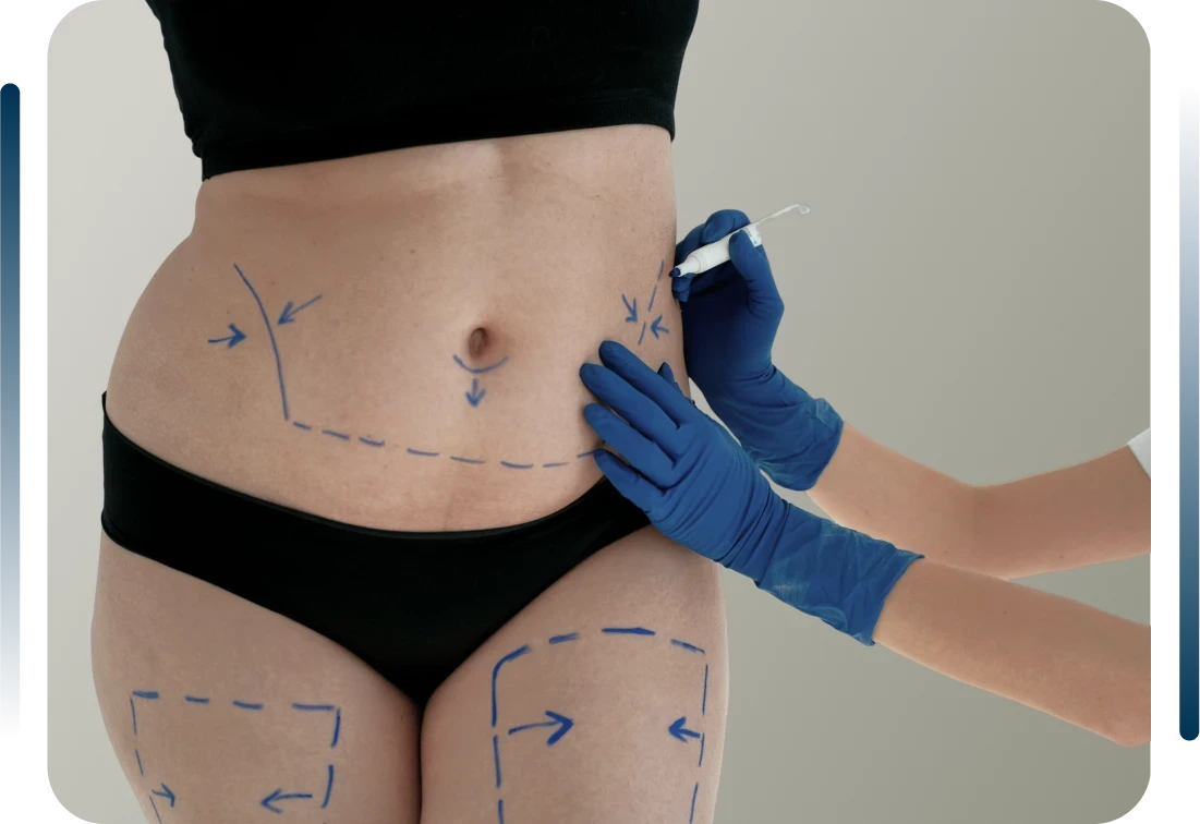 Abdominoplastia em Ribeir&atilde;o Preto <br />com Dr. Rodrigo Rosique