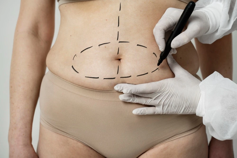 O que &eacute; a BBL Reversal Surgery?