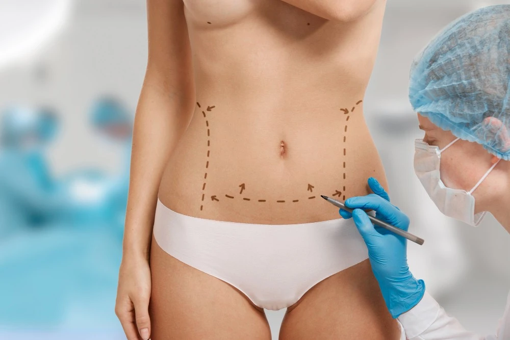 O que &eacute; abdominoplastia e quando ela &eacute; indicada?