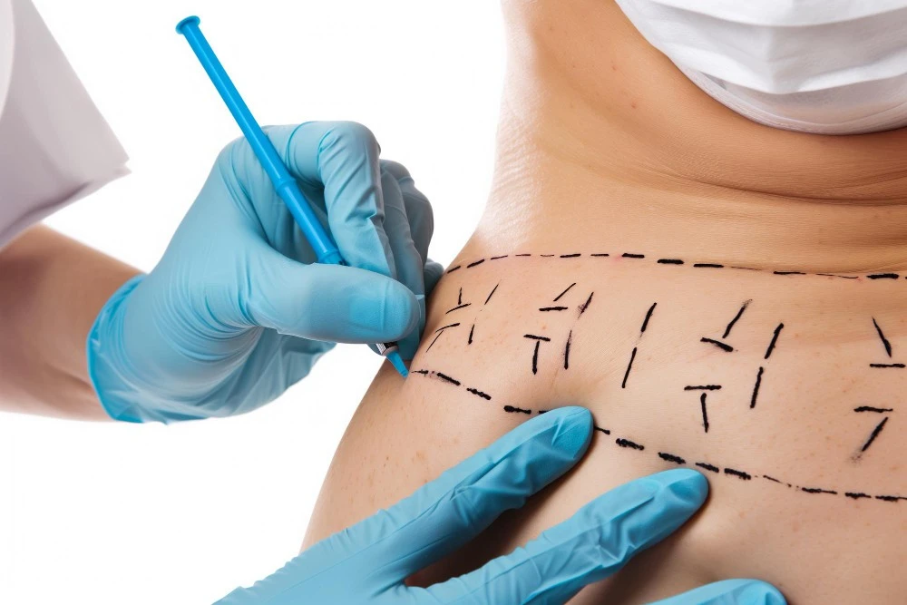 O que &eacute; lipoescultura e quando ela &eacute; indicada?