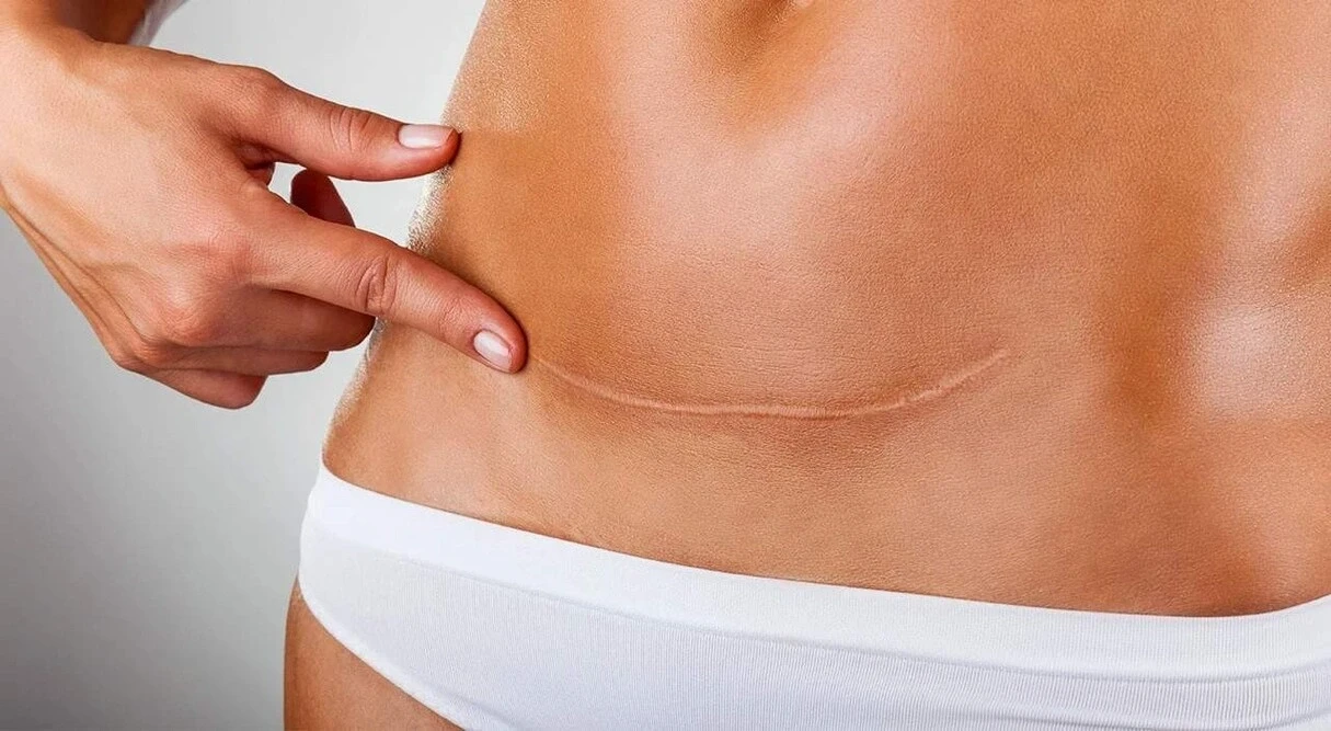 Quando &eacute; poss&iacute;vel refinar a cicatriz da abdominoplastia?