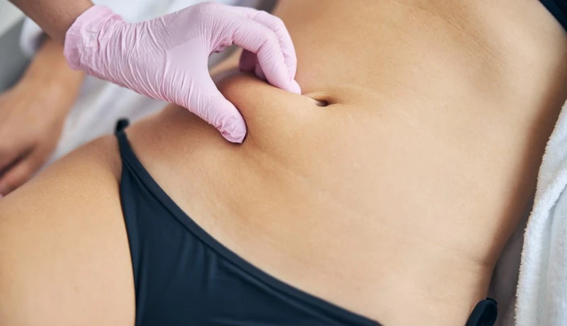 Abdominoplastia de Revisão: entenda como corrigir cicatrizes e contornos após cirurgias prévias