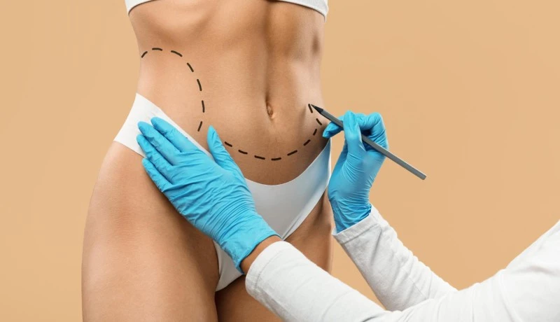 Quando a Cirurgia de Revisão de Lipoaspiração é necessária?