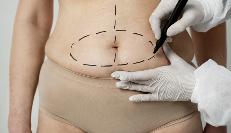 Cirurgia de reversão do BBL com segurança, critério e naturalidade