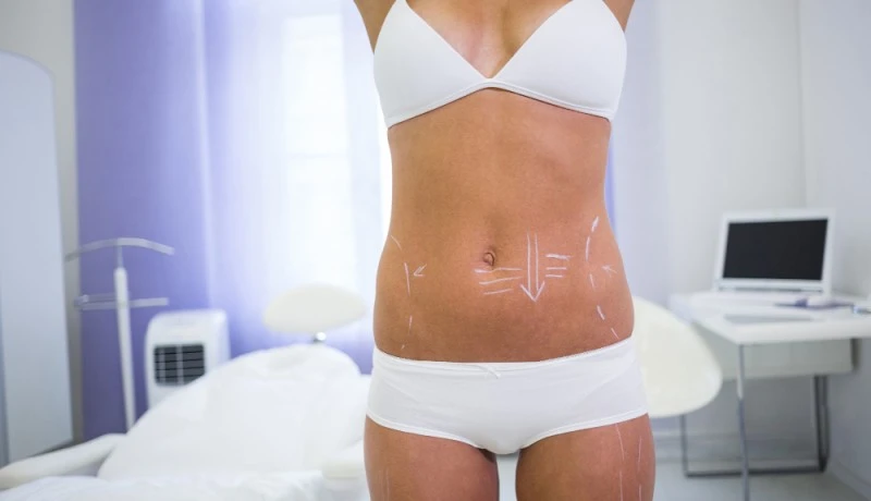 Plástica de abdômen em Ribeirão Preto: quando a abdominoplastia pode transformar contorno e autoestima