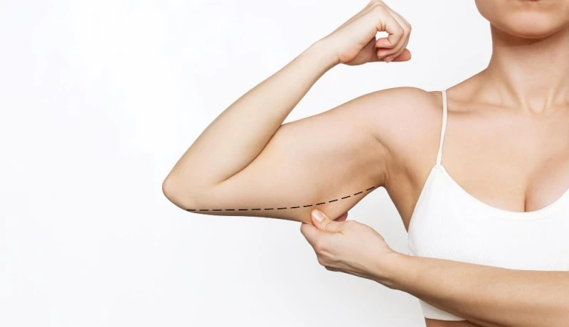 Cirurgia para flacidez dos braços em Ribeirão Preto: como a braquioplastia redefine o contorno corporal
