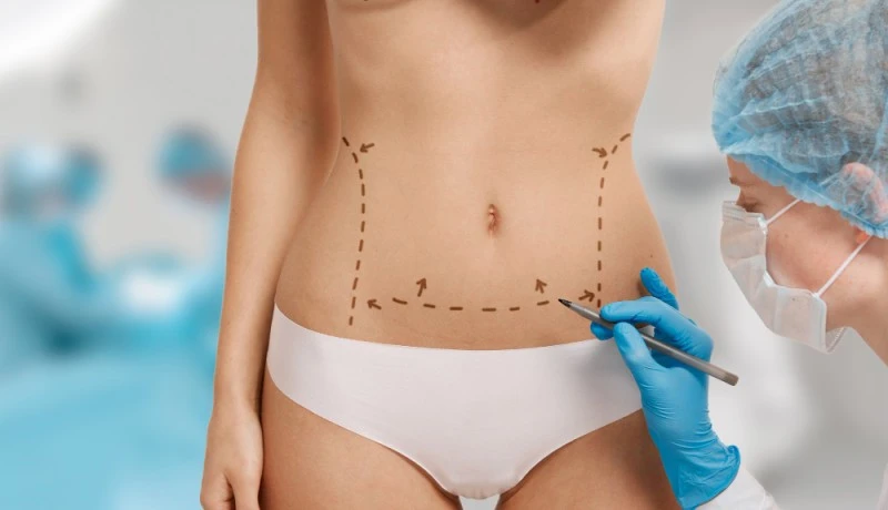 Qual a diferença entre abdominoplastia, lipoaspiração e lipoescultura?