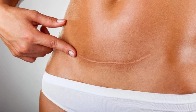 Quando é possível refinar a cicatriz da abdominoplastia?